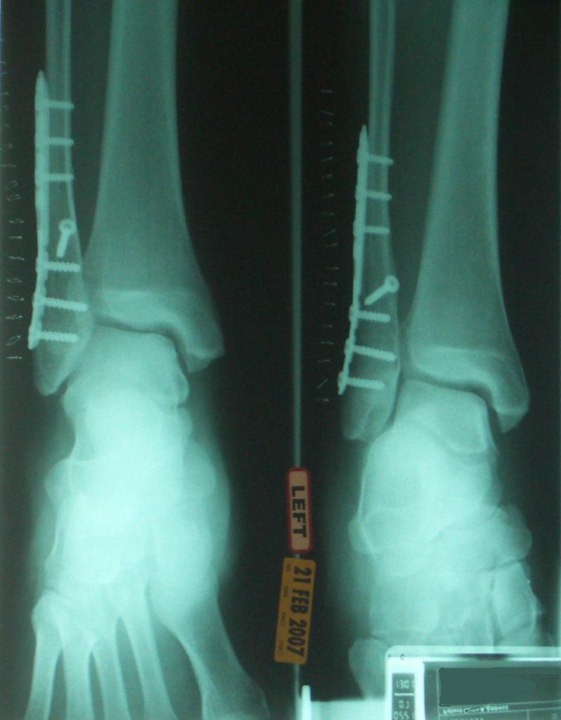 Heavy Metal Leg!